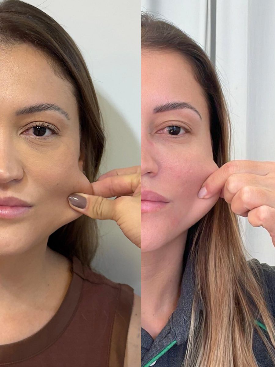 Antes e depois bioestimulador de colágeno — firmeza e qualidade da pele — Dra. Mariana Castanho Araçatuba