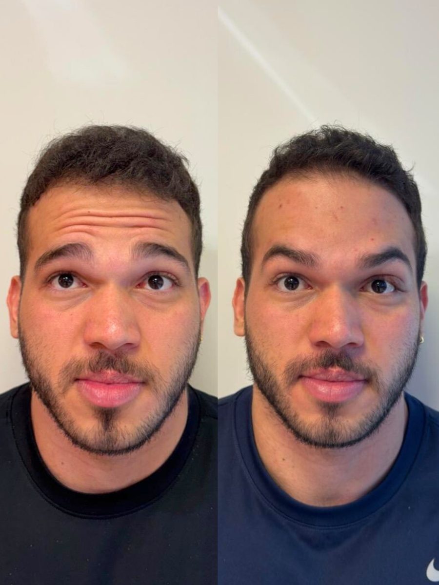 Antes e depois Toxina Botulínica — suavização de rugas na testa — Dra. Mariana Castanho Araçatuba