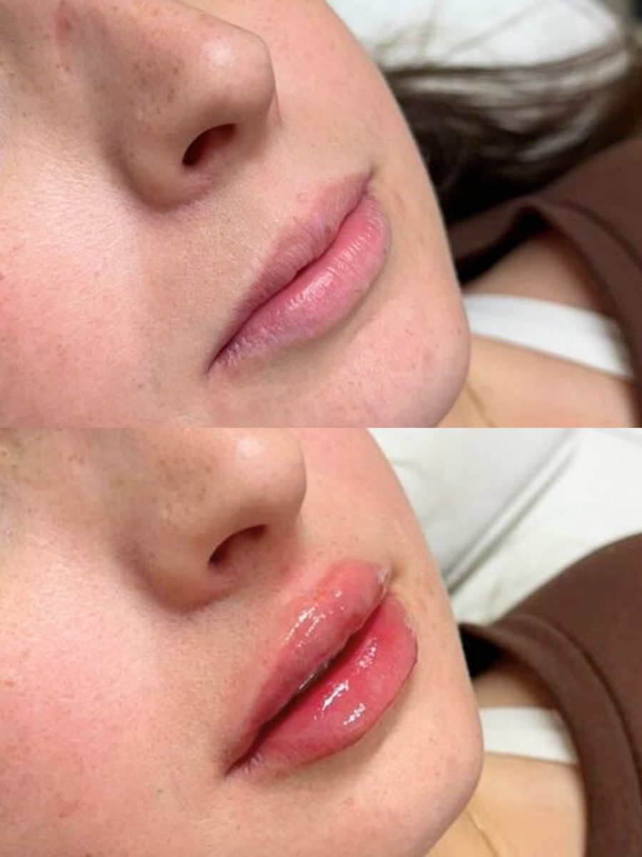 Antes e depois preenchimento labial — volume natural nos lábios — Dra. Mariana Castanho Araçatuba
